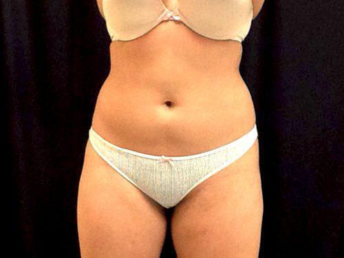 Before Image: CoolSculpting - front