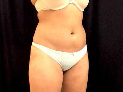 Before Image: CoolSculpting - right-front-oblique