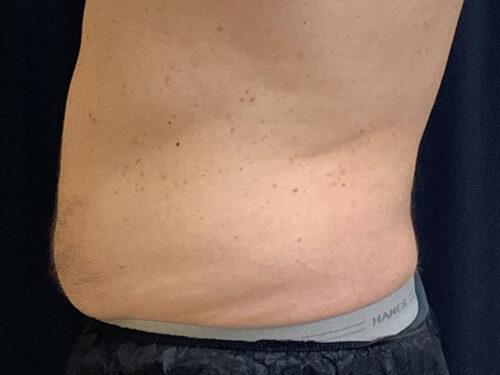 After Image: CoolSculpting - left-side