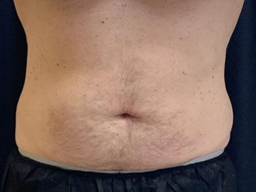After Image: CoolSculpting - front