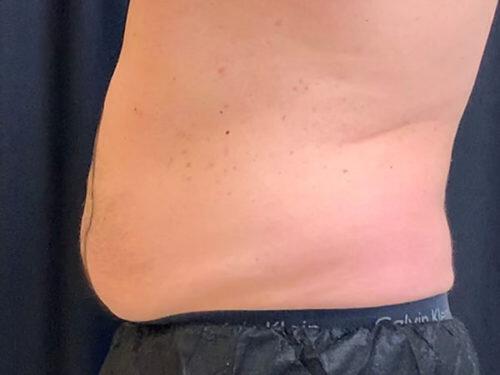 Before Image: CoolSculpting - left-side