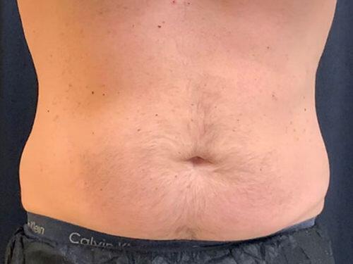 Before Image: CoolSculpting - front