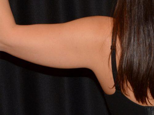 After Image: CoolSculpting - back