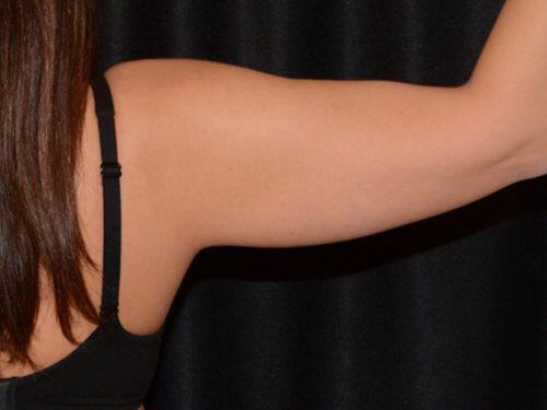 After Image: CoolSculpting - back