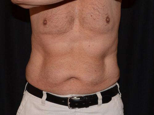 After Image: CoolSculpting - front