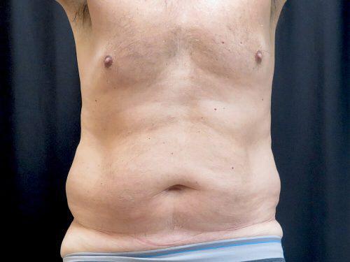 Before Image: CoolSculpting - front