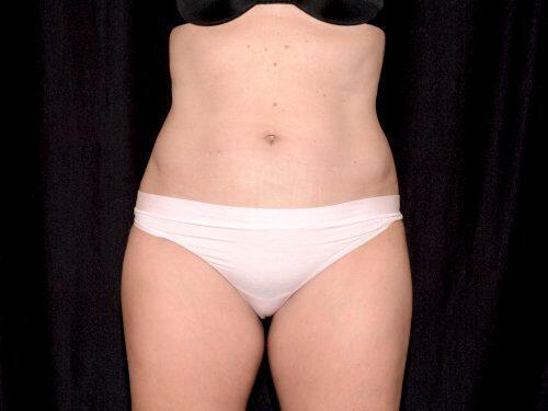 After Image: CoolSculpting - front