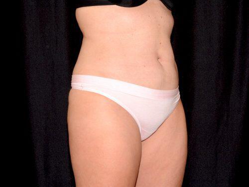 After Image: CoolSculpting - right-front-oblique