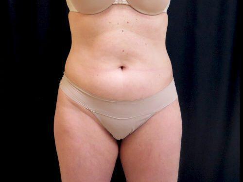 Before Image: CoolSculpting - front