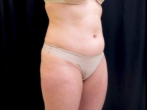 Before Image: CoolSculpting - right-front-oblique