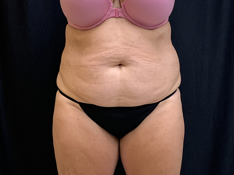 After Image: CoolSculpting - front