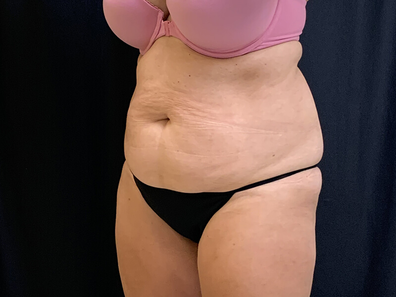 After Image: CoolSculpting - left-front-oblique