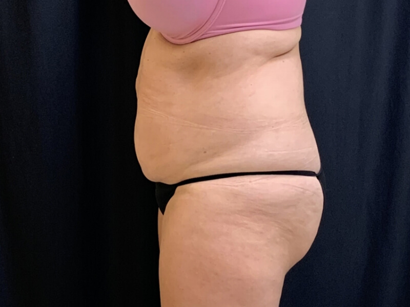 After Image: CoolSculpting - left-side