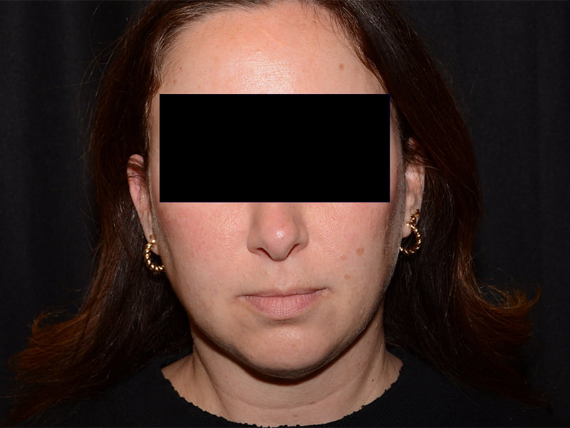 After Image: CoolSculpting - front