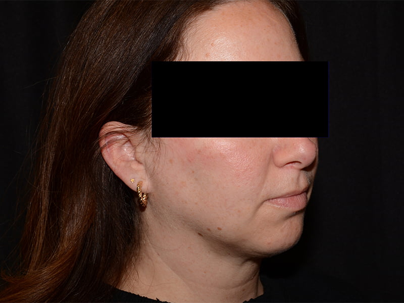 After Image: CoolSculpting - right-front-oblique