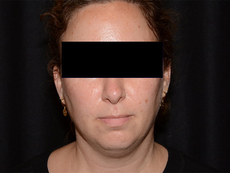 Before Image: CoolSculpting - front