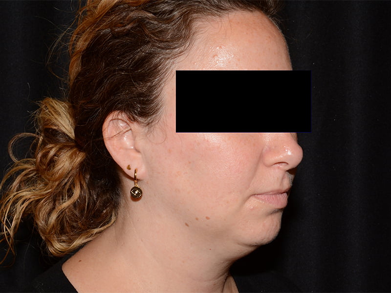 Before Image: CoolSculpting - right-front-oblique