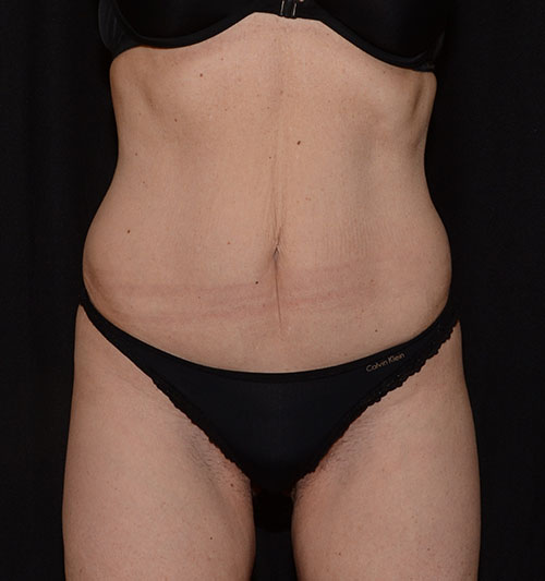After Image: CoolSculpting - front