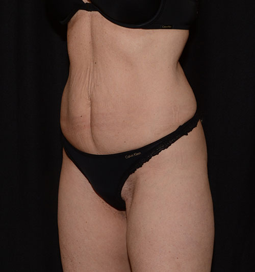 After Image: CoolSculpting - left-front-oblique