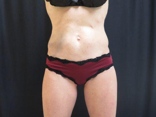 After Image: CoolSculpting - front