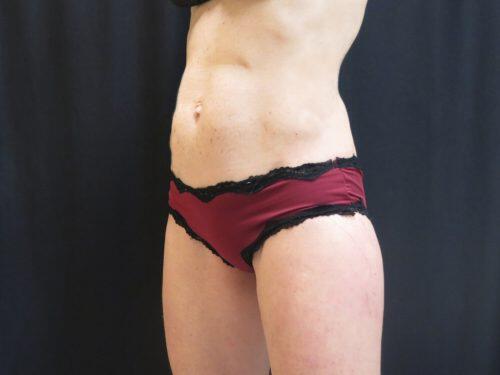 After Image: CoolSculpting - left-front-oblique