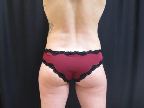 After Image: CoolSculpting - back