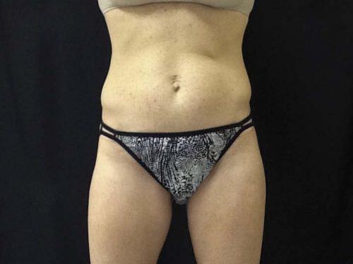 Before Image: CoolSculpting - front