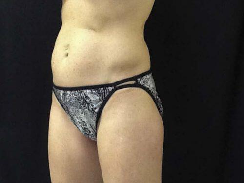 Before Image: CoolSculpting - left-front-oblique