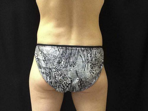 Before Image: CoolSculpting - back