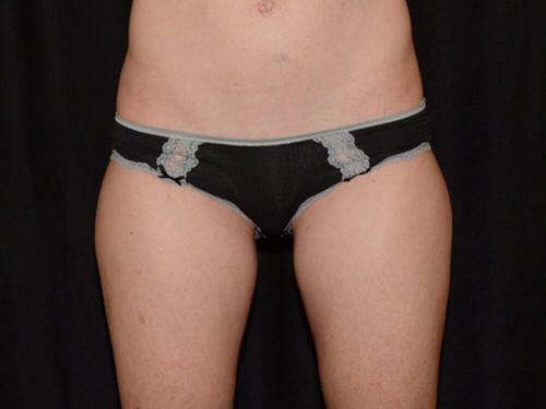 After Image: CoolSculpting - front