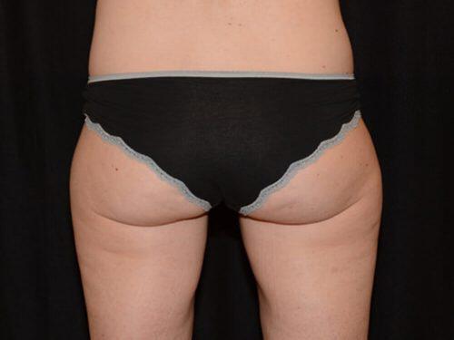 After Image: CoolSculpting - back
