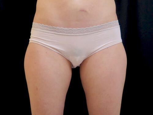 Before Image: CoolSculpting - front