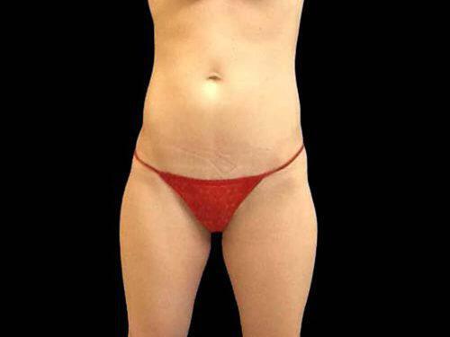 Before Image: CoolSculpting - front