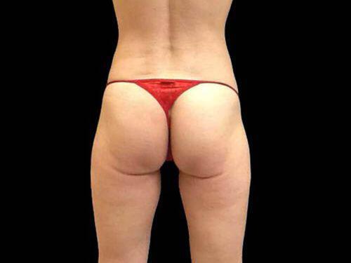 Before Image: CoolSculpting - back