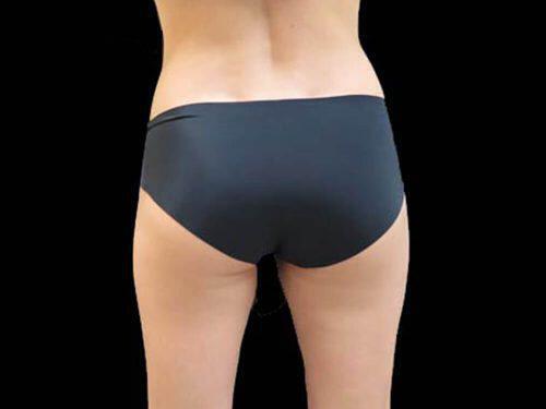 After Image: CoolSculpting - back