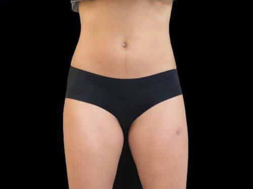 After Image: CoolSculpting - front
