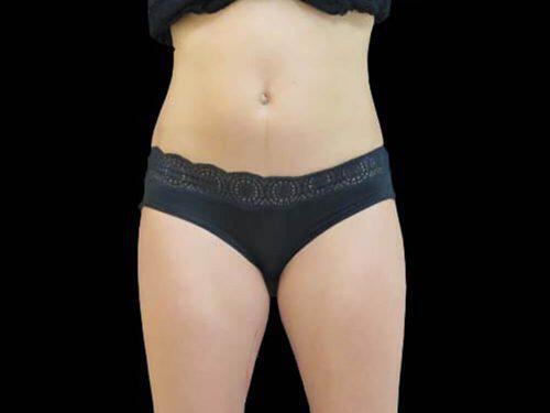 Before Image: CoolSculpting - front