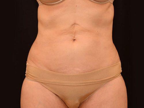 After Image: CoolSculpting - front