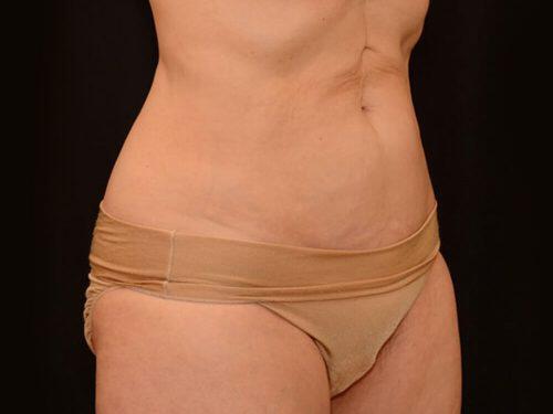 After Image: CoolSculpting - right-front-oblique