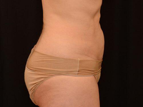 After Image: CoolSculpting - right-side