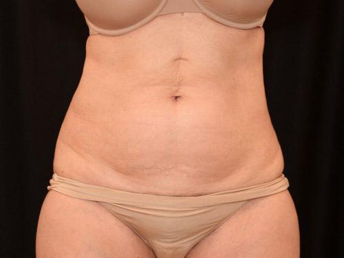 Before Image: CoolSculpting - front