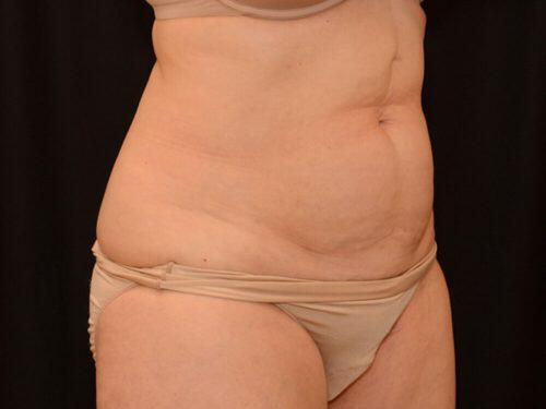 Before Image: CoolSculpting - right-front-oblique