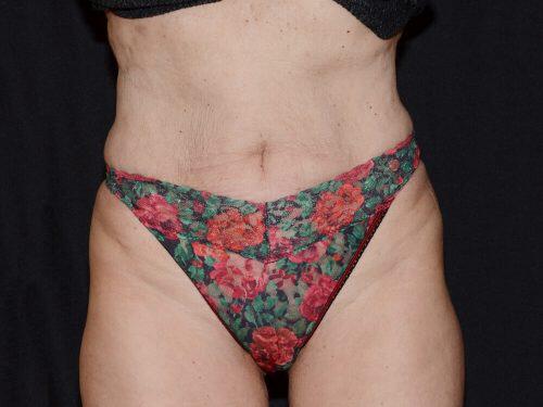 After Image: CoolSculpting - front