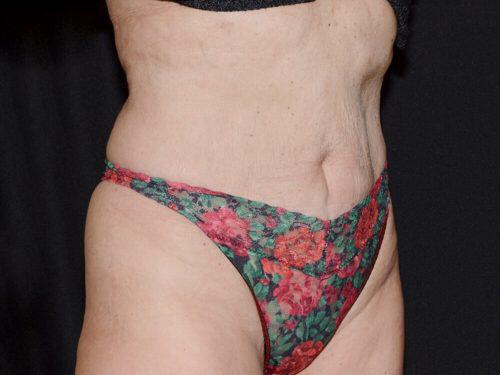 After Image: CoolSculpting - right-front-oblique