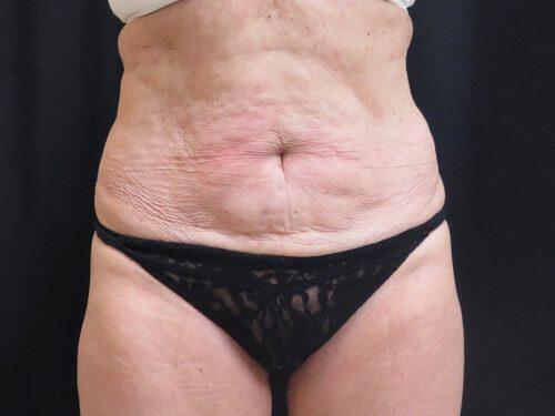 Before Image: CoolSculpting - front