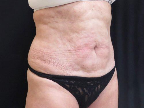 Before Image: CoolSculpting - right-front-oblique