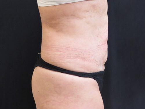 Before Image: CoolSculpting - right-side