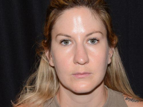 After Image: CoolSculpting - front