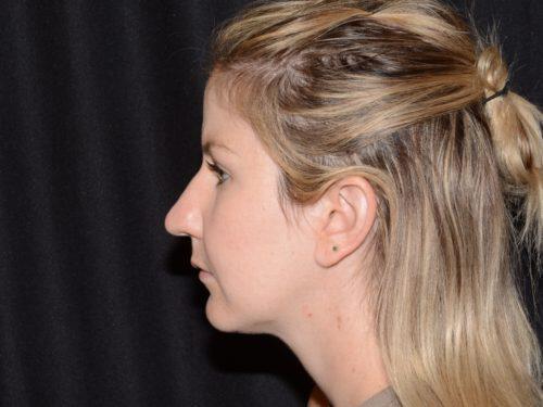 After Image: CoolSculpting - left-side