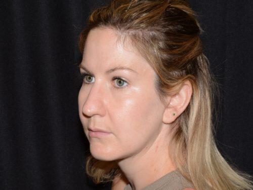 After Image: CoolSculpting - left-front-oblique